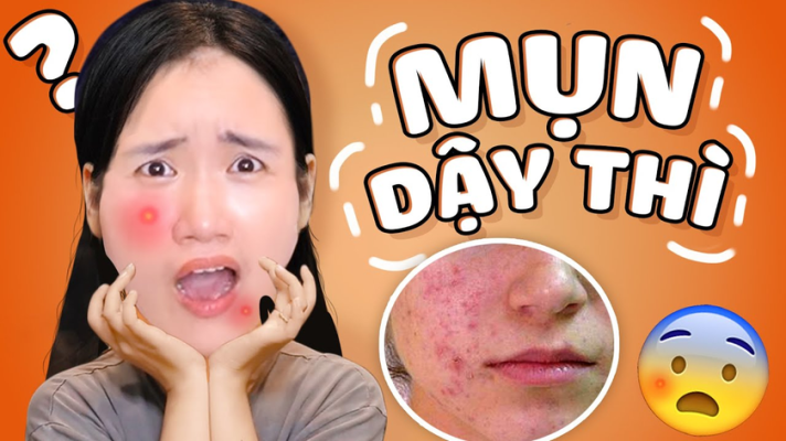 trị mụn trứng cá tại nhà